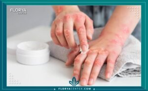 روتين العناية بالبشرة بعد الحروق الطفيفة