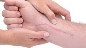 أفضل كريم بعد العمليات الجراحية 